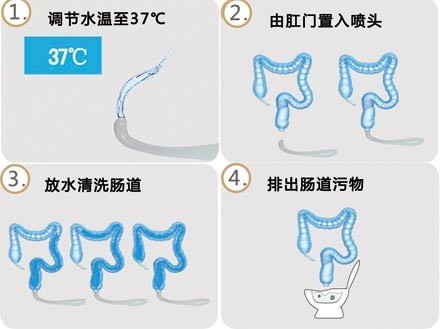 便秘治疗过程