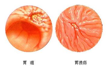 胃溃疡
